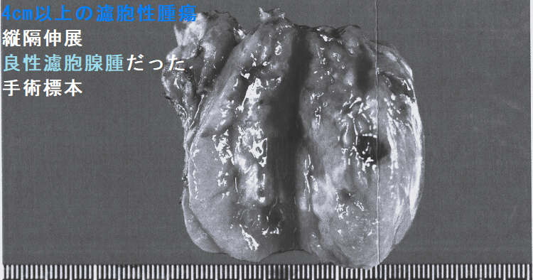 4cm以上の濾胞性腫瘍 縦隔伸展 良性濾胞腺腫だった 手術標本 4cm以上の濾胞性腫瘍 縦隔伸展 良性濾胞腺腫だった 手術標本1-2