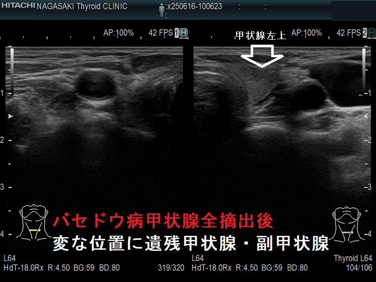 バセドウ病甲状腺全摘出後 変な位置に遺残甲状腺・副甲状腺 バセドウ病甲状腺全摘出後 変な位置に遺残甲状腺・副甲状腺