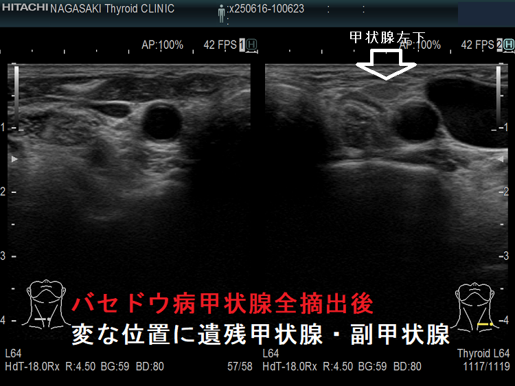 バセドウ病甲状腺全摘出後 変な位置に遺残甲状腺・副甲状腺2 バセドウ病甲状腺全摘出後 変な位置に遺残甲状腺・副甲状腺2