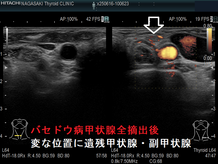 バセドウ病甲状腺全摘出後 変な位置に遺残甲状腺・副甲状腺 ドプラーモード バセドウ病甲状腺全摘出後 変な位置に遺残甲状腺・副甲状腺 ドプラーモード