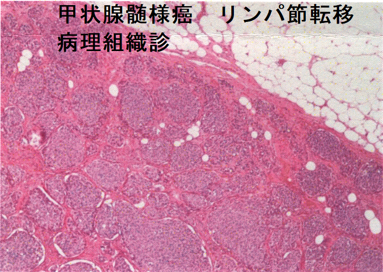 甲状腺髄様癌 リンパ節転移 病理組織診 HE染色 甲状腺髄様癌 リンパ節転移 病理組織診 HE染色