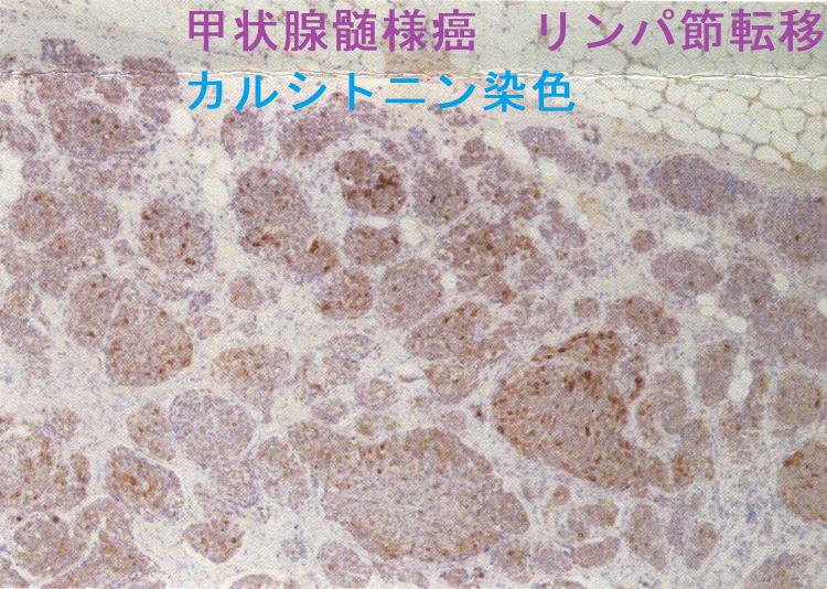 甲状腺髄様癌リンパ節転移 病理組織診 カルシトニン染色 甲状腺髄様癌リンパ節転移 病理組織診 カルシトニン染色