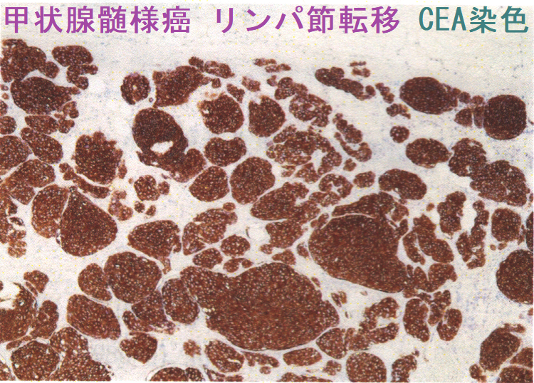 甲状腺髄様癌リンパ節転移 病理組織診 CEA 染色 甲状腺髄様癌リンパ節転移 病理組織診 CEA 染色