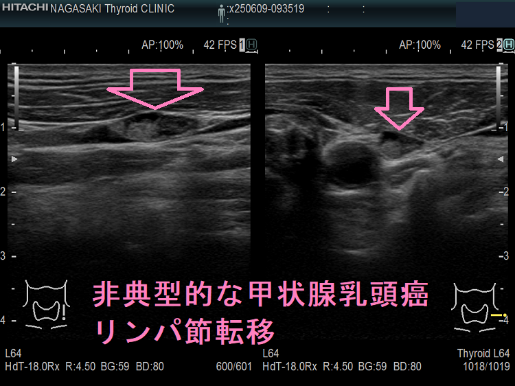 非典型的な甲状腺乳頭癌リンパ節転移 非典型的な甲状腺乳頭癌リンパ節転移1
