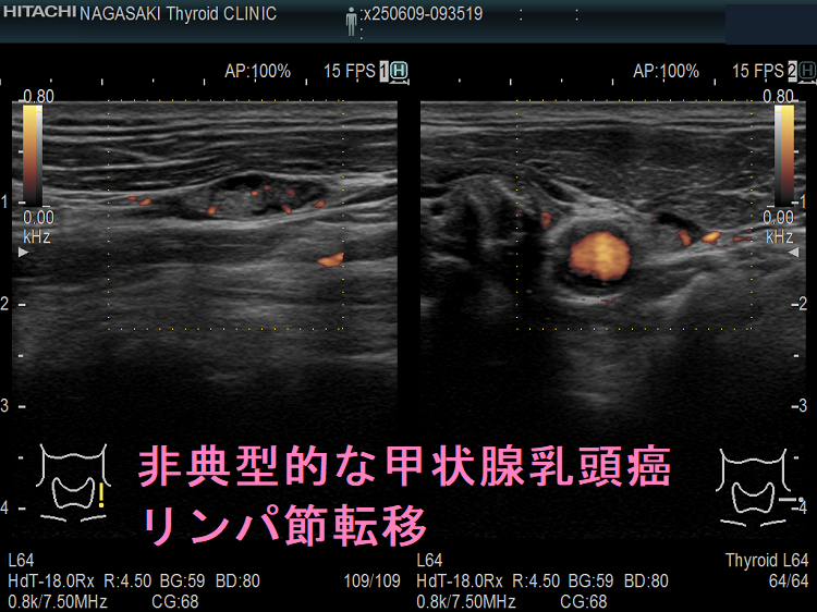 非典型的な甲状腺乳頭癌リンパ節転移ドプラーモード 非典型的な甲状腺乳頭癌リンパ節転移ドプラーモード