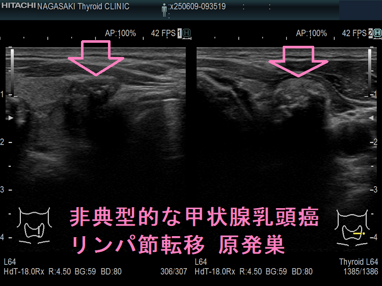 非典型的な甲状腺乳頭癌リンパ節転移 原発巣 非典型的な甲状腺乳頭癌リンパ節転移 原発巣