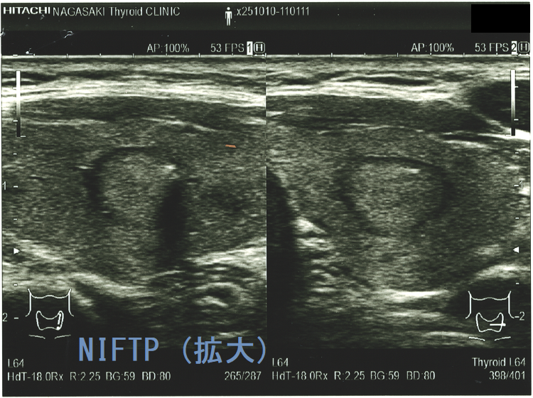 NIFTP 超音波(エコー)画像 (拡大) NIFTP 超音波(エコー)画像 (拡大)