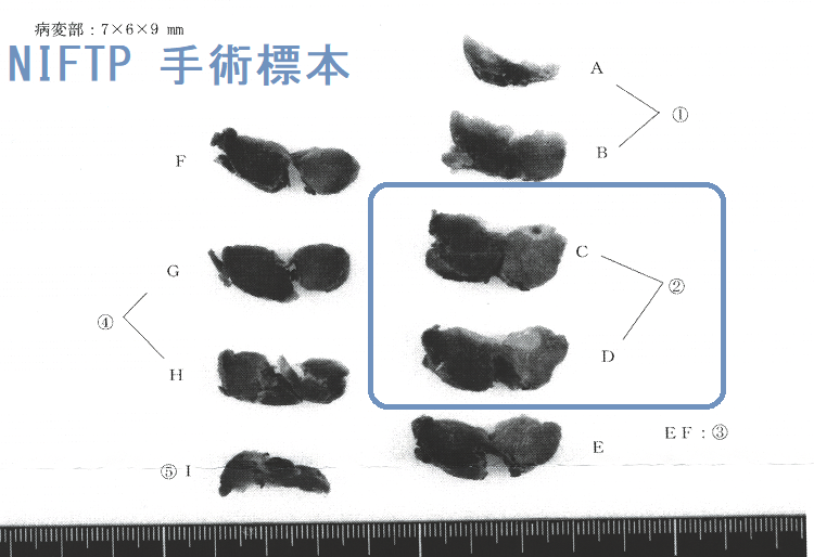 NIFTP 手術標本 (割面) NIFTP 手術標本 (割面)