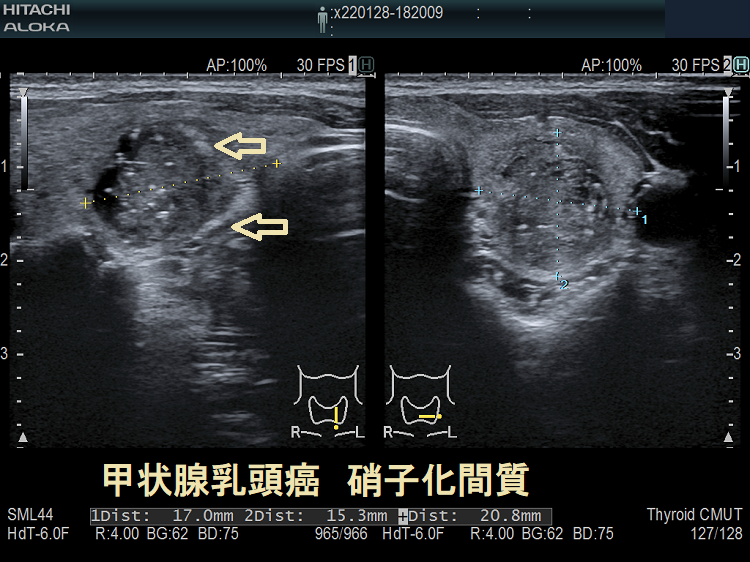 甲状腺乳頭癌 硝子化間質 甲状腺乳頭癌 硝子化間質