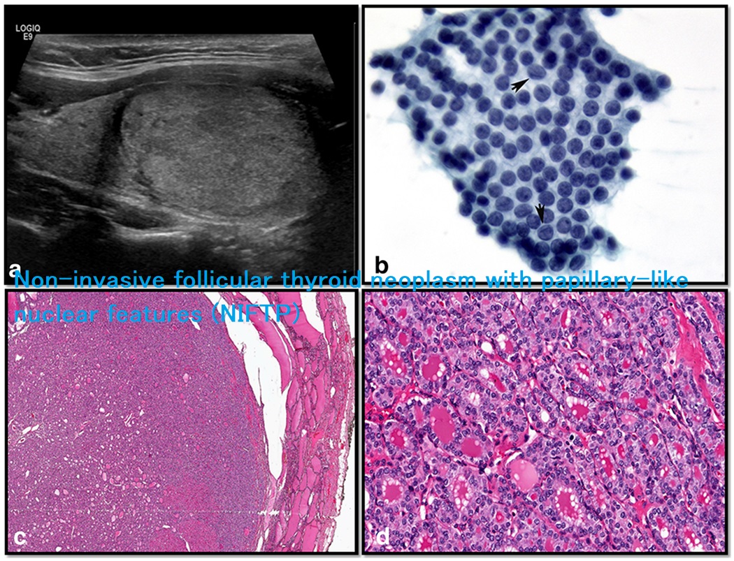 Non-invasive follicular thyroid neoplasm with papillary-like nuclear features (NIFTP) Non-invasive follicular thyroid neoplasm with papillary-like nuclear features (NIFTP)