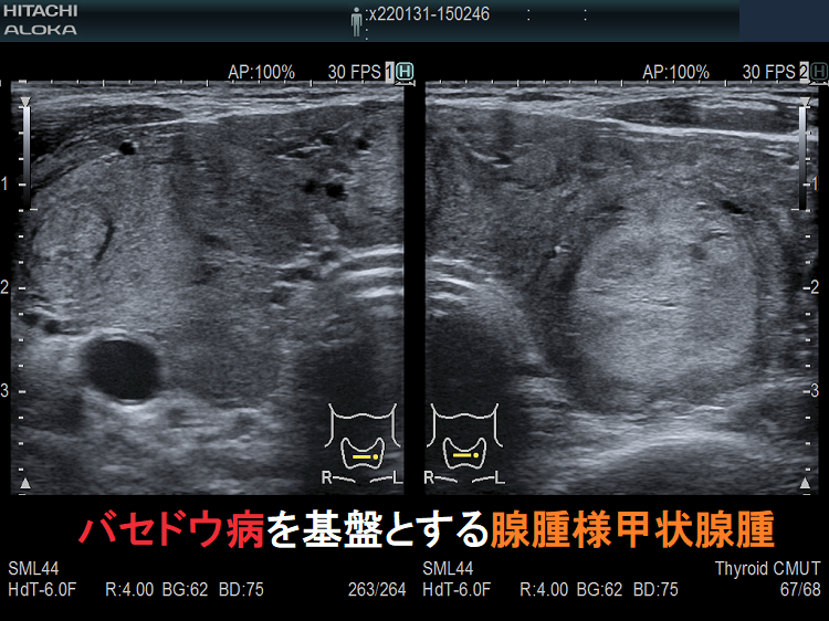 バセドウ病を基盤とする腺腫様甲状腺腫 超音波(エコー)画像 バセドウ病を基盤とする腺腫様甲状腺腫 超音波(エコー)画像