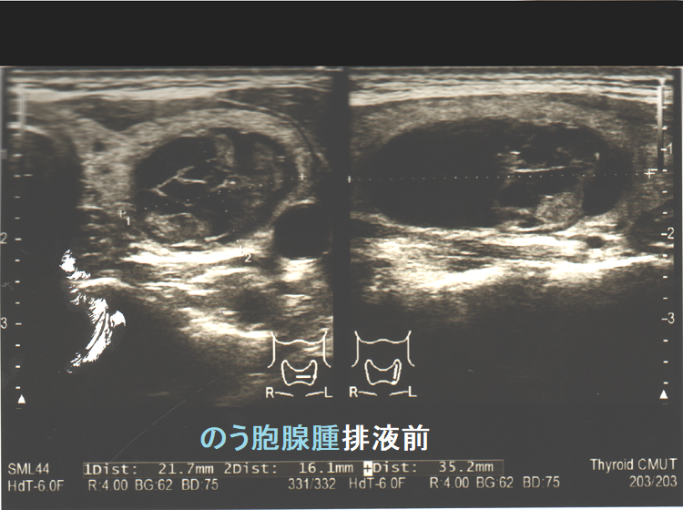 甲状腺のう胞腺腫 排液前 甲状腺のう胞腺腫 排液前