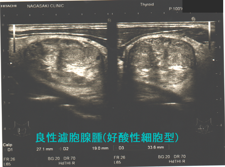 腺腫様甲状腺腫・腺腫様結節[橋本病 バセドウ病 甲状腺超音波