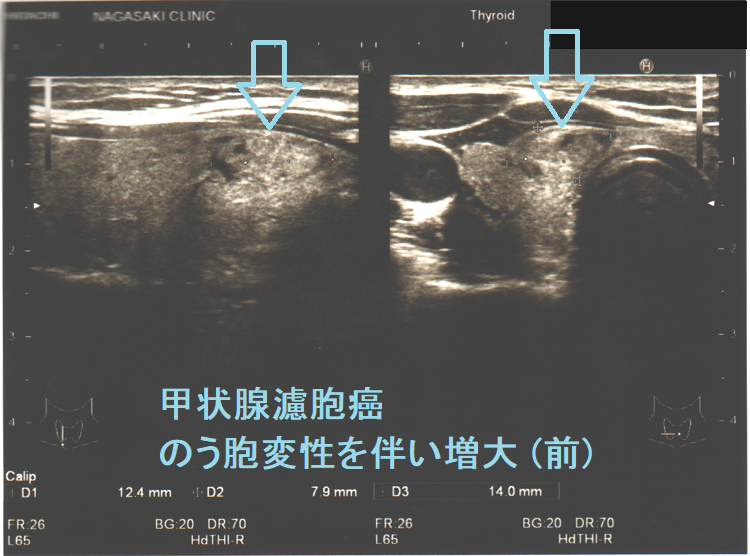 のう胞変性を伴い、急速な増大の濾胞癌 のう胞変性を伴い、急速な増大の濾胞癌
