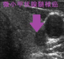 甲状腺微小髄様癌 超音波(エコー)画像 甲状腺微小髄様癌 超音波(エコー)画像