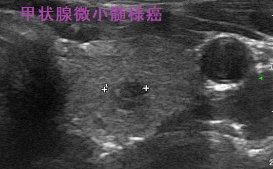 甲状腺微小髄様癌 超音波(エコー)画像 甲状腺微小髄様癌 超音波(エコー)画像