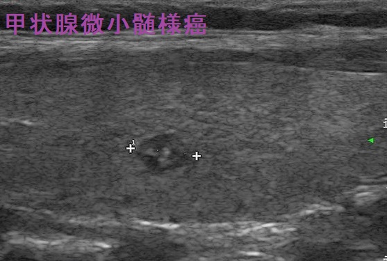 甲状腺微小髄様癌 超音波(エコー)画像 甲状腺微小髄様癌 超音波(エコー)画像