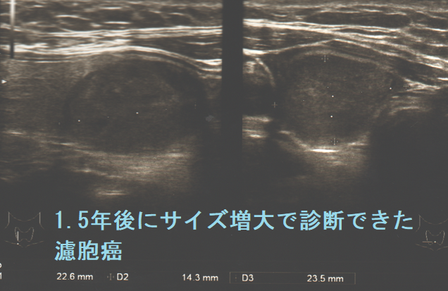 濾胞性腫瘍としか診断できず濾胞癌(1.5年前) 濾胞癌 1.5年後3