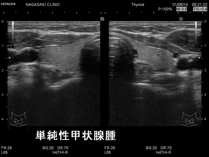 単純性甲状腺腫 超音波(エコー)画像 単純性甲状腺腫 超音波(エコー)画像