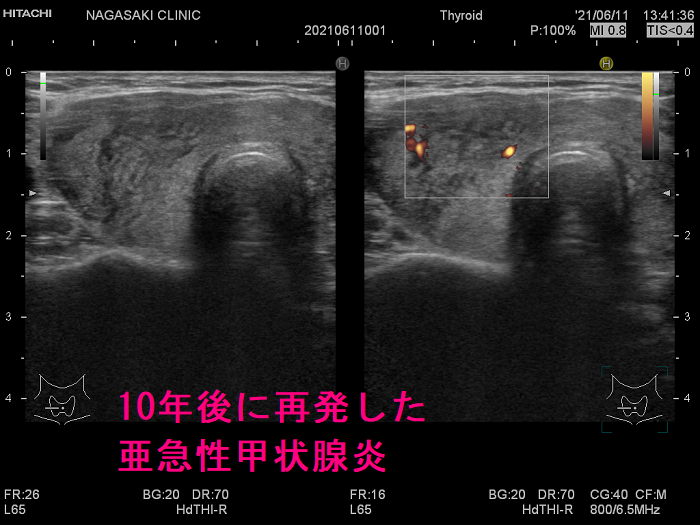 10年後に再発した亜急性甲状腺炎 超音波(エコー)画像 ドプラー 10年後に再発した亜急性甲状腺炎 超音波(エコー)画像 ドプラー