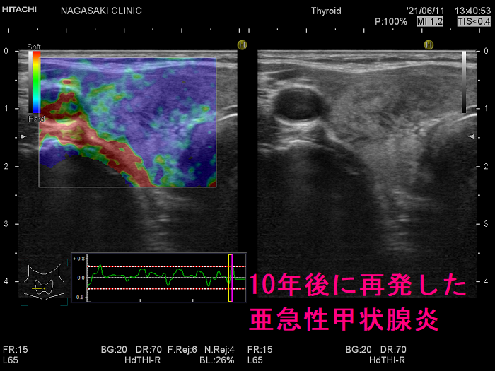 10年後に再発した亜急性甲状腺炎 超音波(エコー)画像 エラストグラフィー 10年後に再発した亜急性甲状腺炎 超音波(エコー)画像 エラストグラフィー