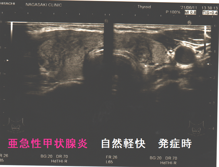 自然軽快した亜急性甲状腺炎(発症時) 自然軽快した亜急性甲状腺炎(発症時)