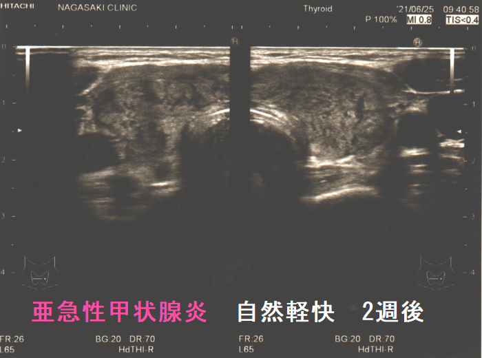 自然軽快した亜急性甲状腺炎(2週間後) 自然軽快した亜急性甲状腺炎(2週間後)