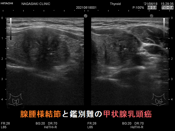 甲状腺乳頭癌(腺腫様結節との鑑別難) 腺腫様結節と鑑別難の甲状腺乳頭癌