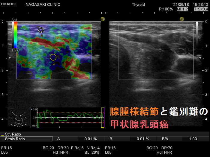 甲状腺乳頭癌(腺腫様結節との鑑別難)エラストグラフィー 腺腫様結節と鑑別難の甲状腺乳頭癌 エラストグラフィー