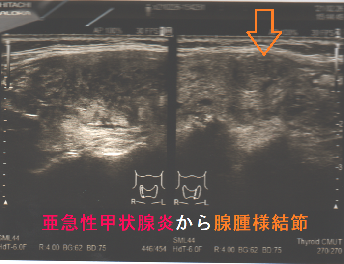 亜急性甲状腺炎が沈静化後に腺腫様結節 亜急性甲状腺炎が沈静化後に腺腫様結節