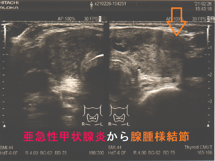 亜急性甲状腺炎が沈静化後に腺腫様結節 亜急性甲状腺炎が沈静化後に腺腫様結節