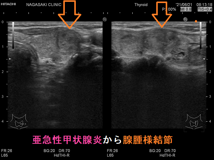 亜急性甲状腺炎が沈静化後に腺腫様結節に 亜急性甲状腺炎が沈静化後に腺腫様結節に