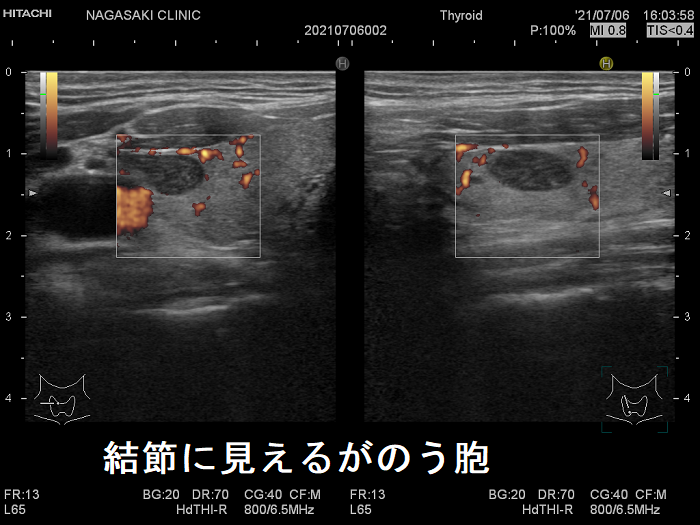 腺腫様結節に見えるが甲状腺のう胞 腺腫様結節に見えるが甲状腺のう胞