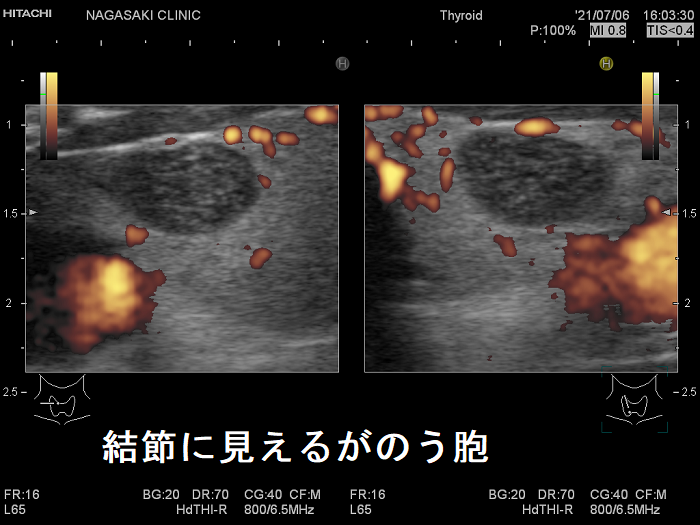 腺腫様結節に見えるが甲状腺のう胞(拡大) 腺腫様結節に見えるが甲状腺のう胞(拡大)