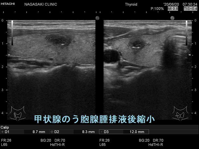 甲状腺のう胞腺腫排液後縮小 超音波(エコー)画像 甲状腺のう胞腺腫排液後縮小 超音波(エコー)画像
