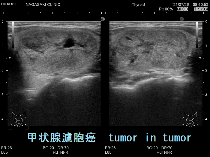 甲状腺濾胞癌 tumor in tumor 甲状腺濾胞癌 tumor in tumor