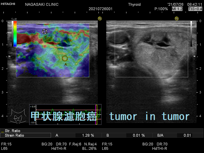 甲状腺濾胞癌 tumor in tumor エラストグラフィー 甲状腺濾胞癌 tumor in tumor エラストグラフィー