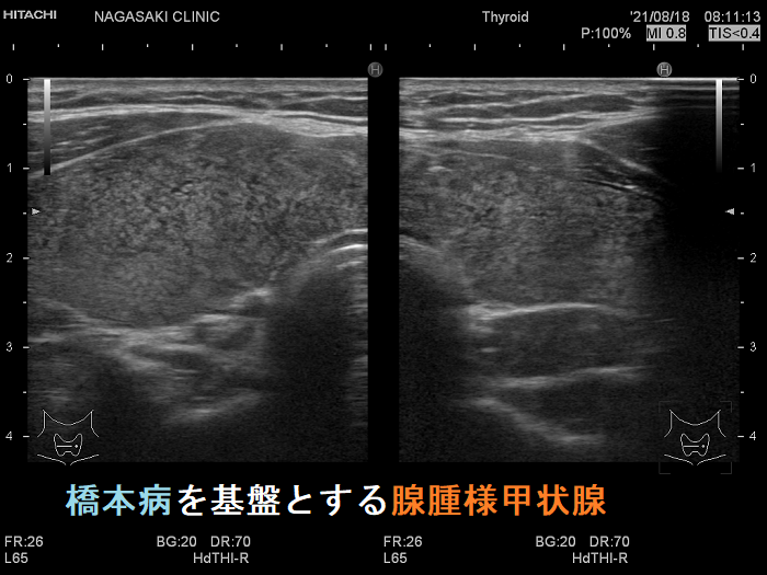 橋本病を基盤とする腺腫様甲状腺腫 橋本病を基盤とする腺腫様甲状腺