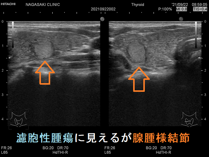 濾胞性腫瘍に見えるが腺腫様結節 超音波(エコー)画像 濾胞性腫瘍に見えるが腺腫様結節 超音波(エコー)画像