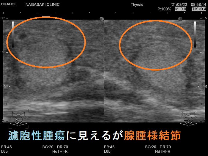 濾胞性腫瘍に見えるが腺腫様結節 超音波(エコー)画像 拡大 濾胞性腫瘍に見えるが腺腫様結節 超音波(エコー)画像 拡大