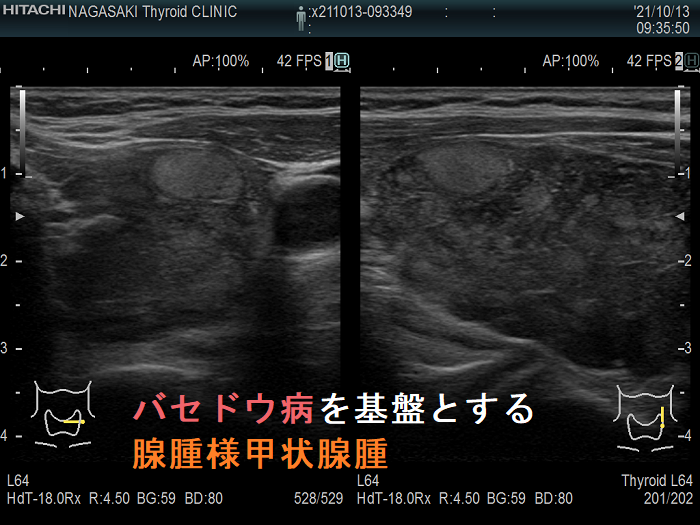 バセドウ病を基盤とする腺腫様甲状腺腫 バセドウ病を基盤とする腺腫様甲状腺腫