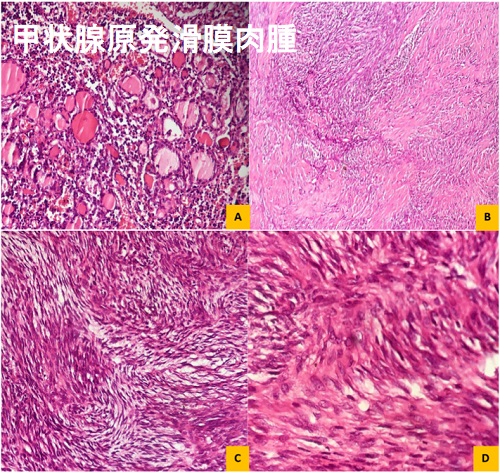 甲状腺原発滑膜肉腫‎‎ 組織 甲状腺原発滑膜肉腫‎‎ 組織