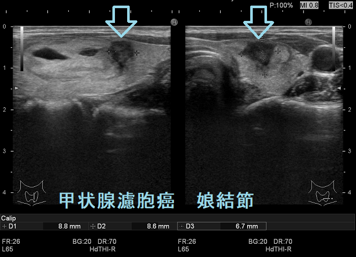甲状腺濾胞癌(娘結節)超音波(エコー)画像 甲状腺濾胞癌(娘結節)超音波(エコー)画像