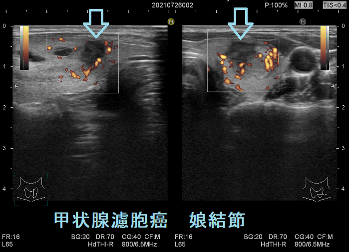 甲状腺濾胞癌(娘結節)超音波(エコー)画像 ドプラー 甲状腺濾胞癌(娘結節)超音波(エコー)画像 ドプラー