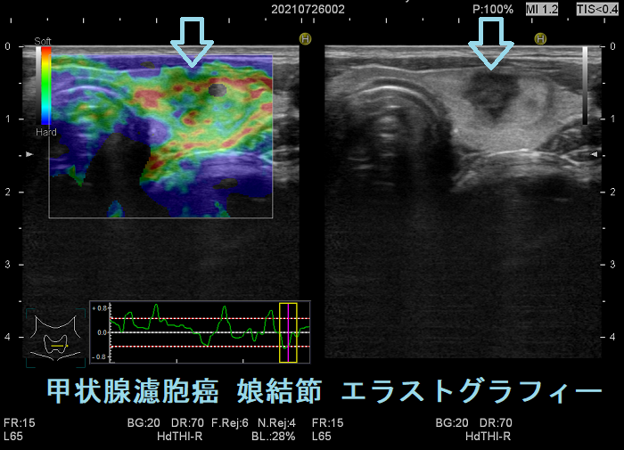 甲状腺濾胞癌(娘結節)超音波(エコー)画像 エラストグラフィー 甲状腺濾胞癌(娘結節)超音波(エコー)画像 エラストグラフィー