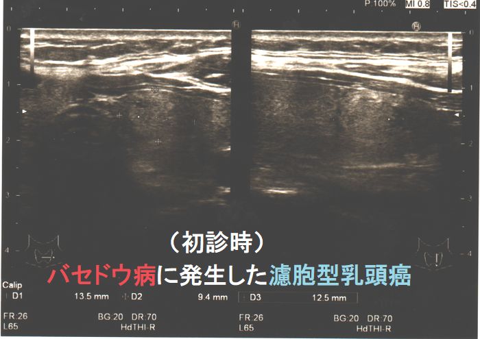 バセドウ病に発生した濾胞型乳頭癌 初診時 バセドウ病に発生した濾胞型乳頭癌 初診時
