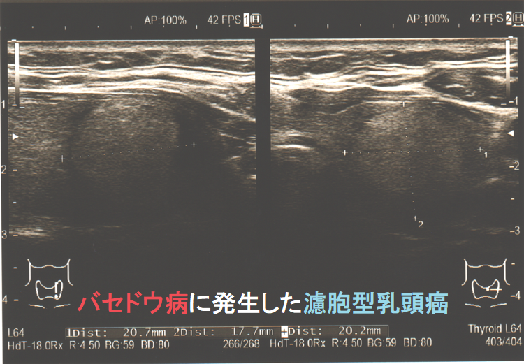 バセドウ病に発生した濾胞型乳頭癌 1年後 バセドウ病に発生した濾胞型乳頭癌 1年後