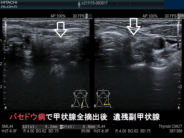 バセドウ病で甲状腺全摘出後 遺残副甲状腺 バセドウ病で甲状腺全摘出後 遺残副甲状腺
