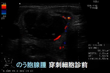 急性化膿性甲状腺炎 のう胞腺腫 穿刺細胞診前 急性化膿性甲状腺炎 のう胞腺腫 穿刺細胞診前