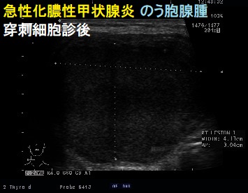 急性化膿性甲状腺炎 のう胞腺腫 穿刺細胞診後 急性化膿性甲状腺炎 のう胞腺腫 穿刺細胞診後